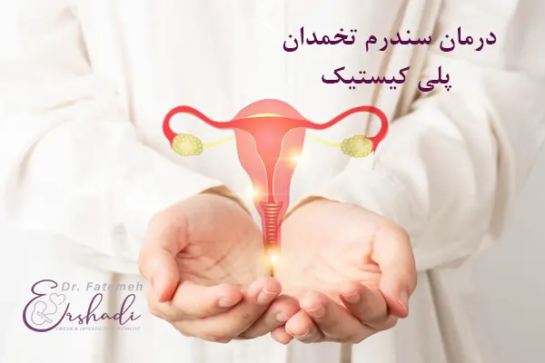 سریعترین درمان تخمدان پلی کیستیک