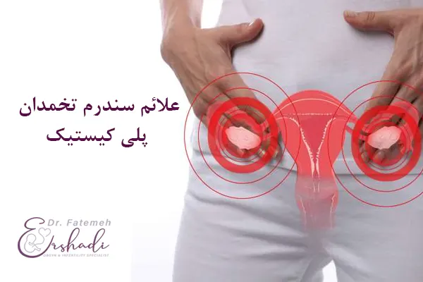 علائم تنبلی تخمدان یا سندروم پلی کیستیک تخمدان