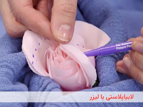 لابیاپلاستی با لیزر