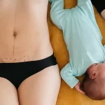 جای بخیه سزارین - دکتر فاطمه ارشادی