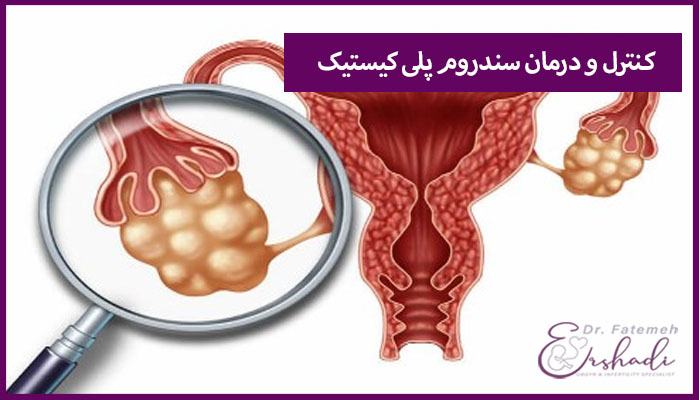 کنترل و درمان سندروم پلی کیستیک